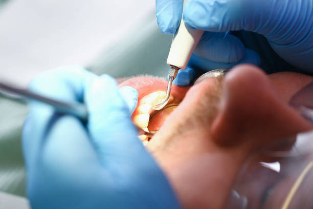 Best Emergency Dentist for Knocked-Out Tooth in Galax, VA